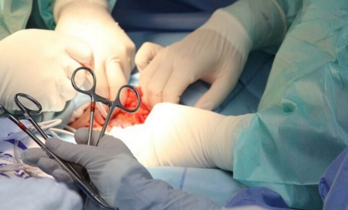 Συνδεσμοτομή – Χειρουργική διεύρυνσης πέους